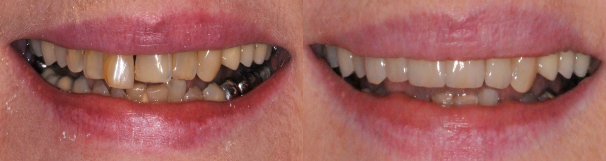 restauration dentaire implantologie