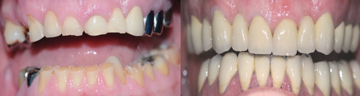 restauration dentaire implantologie