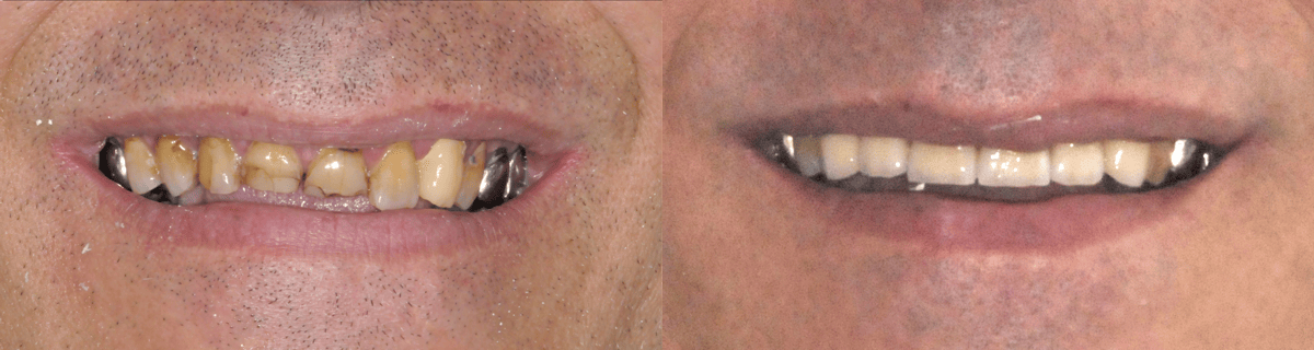 restauration dentaire implantologie